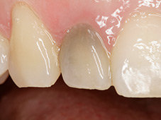 single tooth color correction before 1