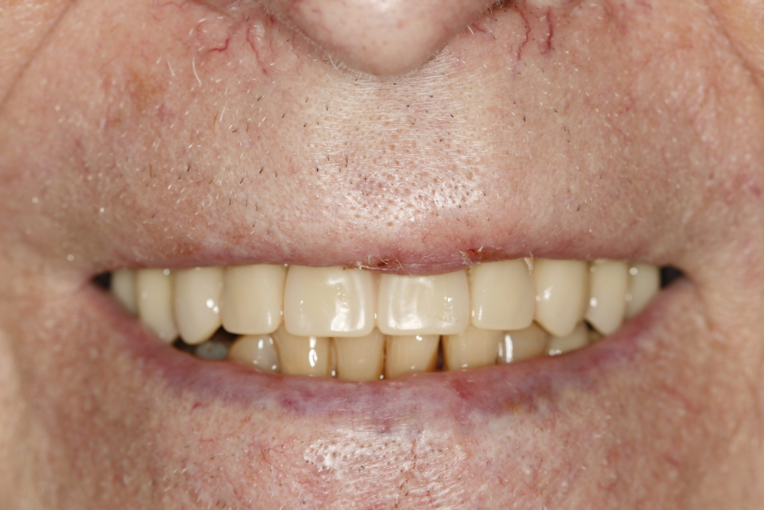 Image of teeth after dentures