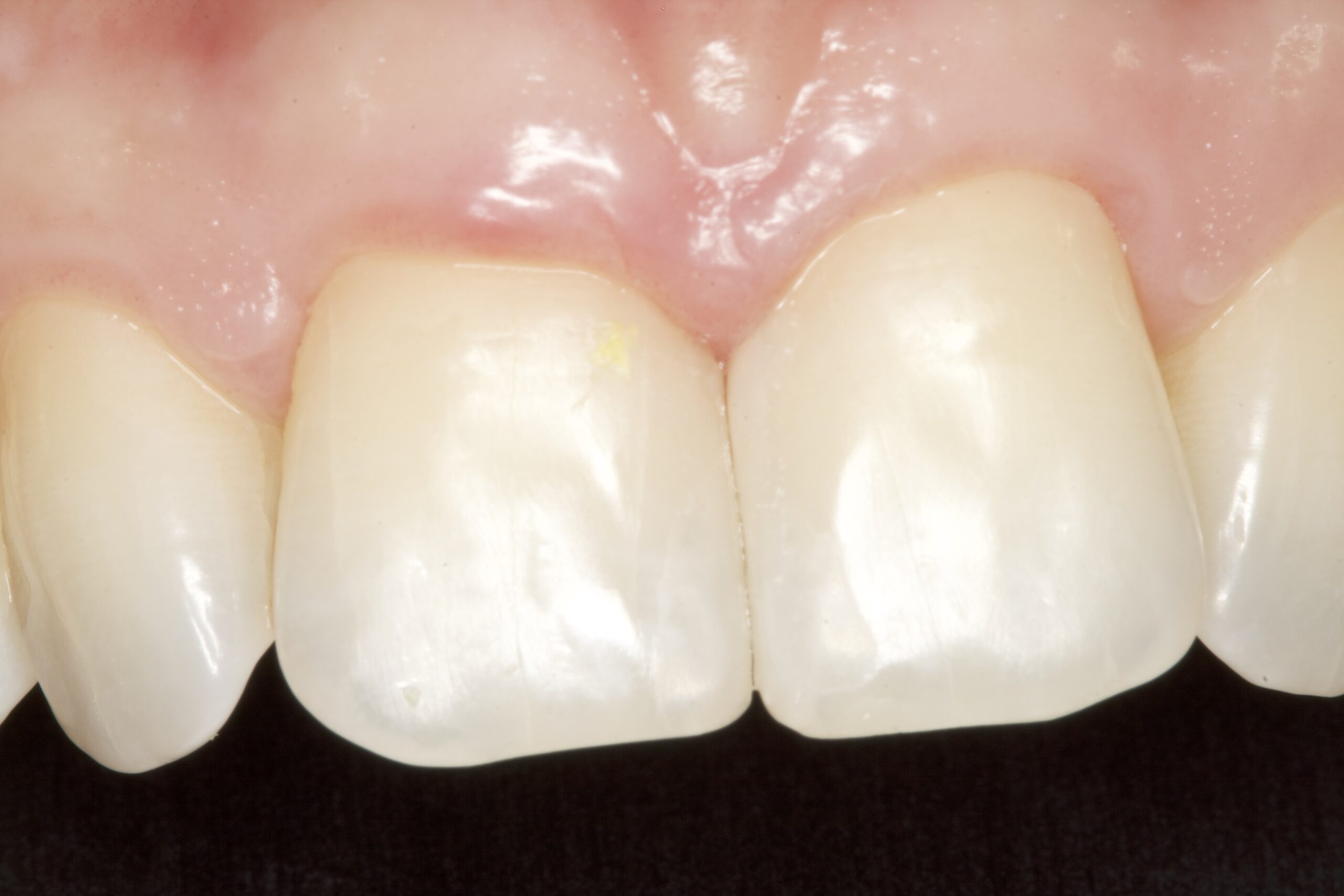 After professional dental bonding showing improved smile