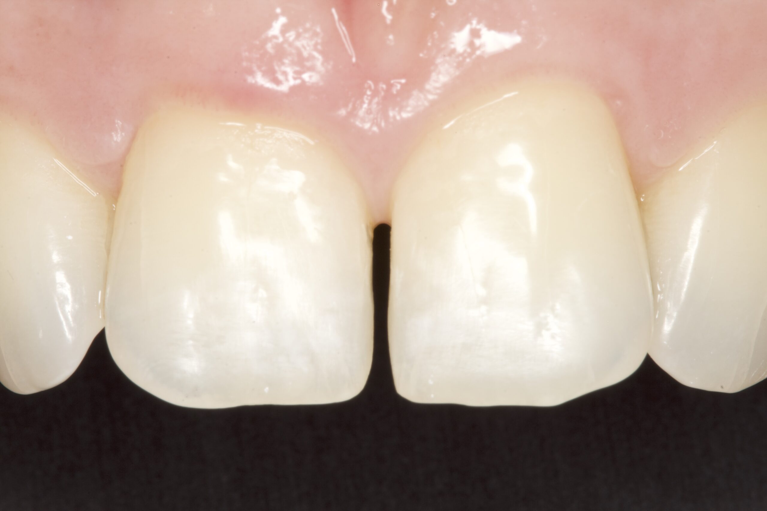 Before professional dental bonding showing problem teeth.