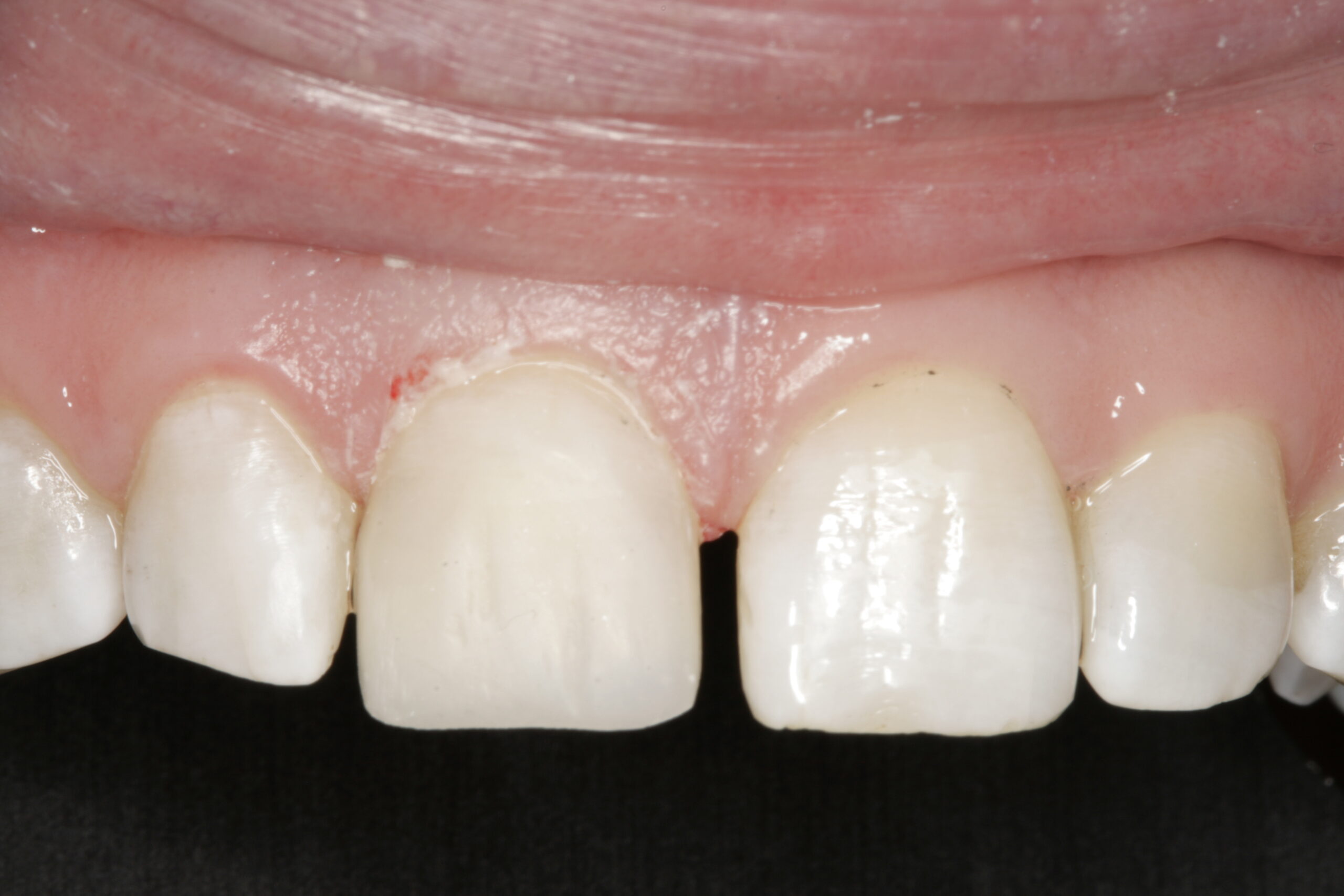 After dental bonding procedure showing improved smile.