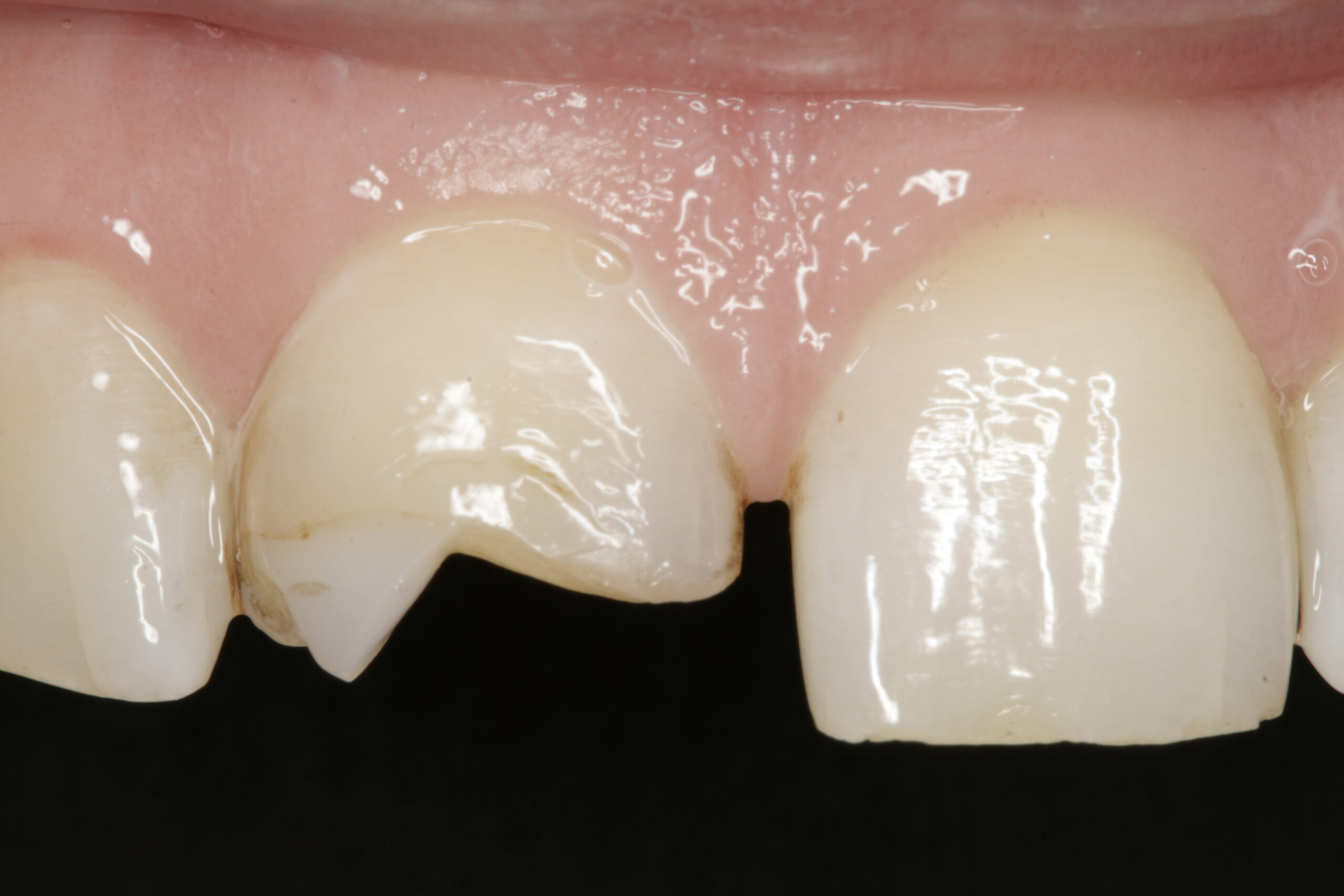 Before dental bonding procedure showing broken teeth.