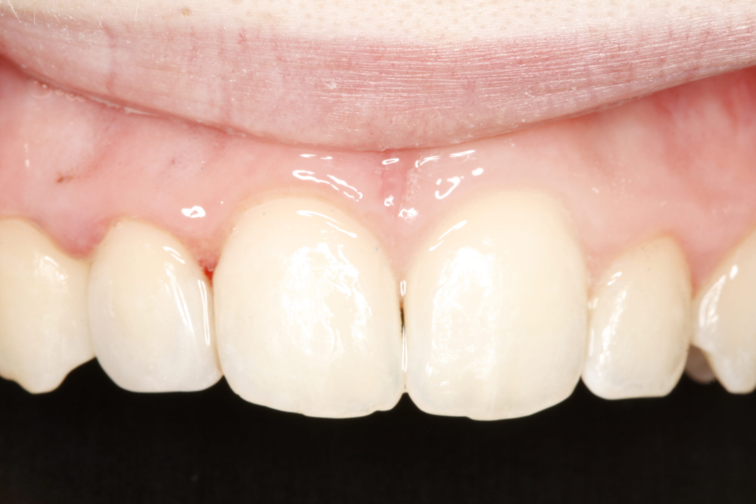 After dental bonding procedure showing improved smile.