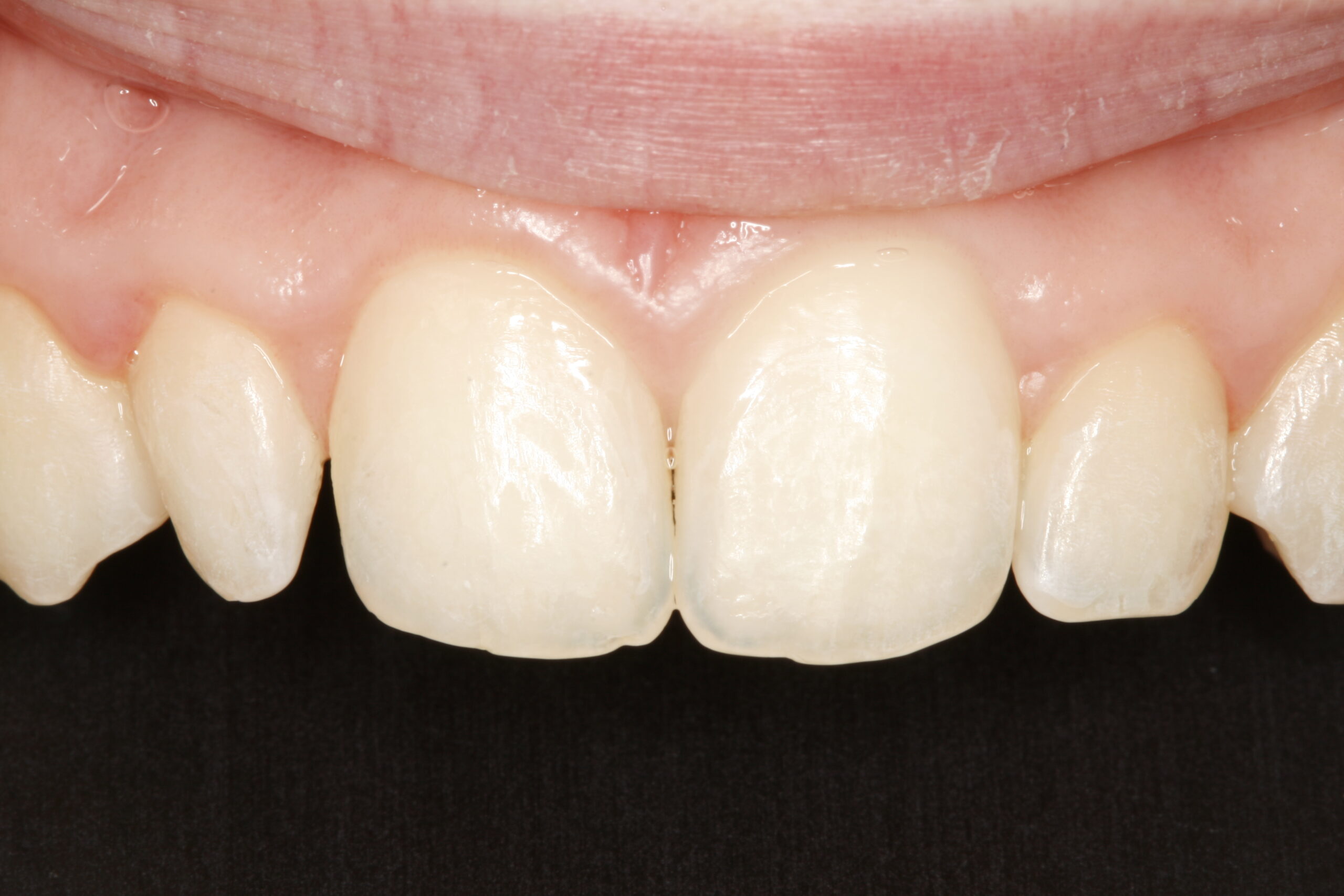 Before dental bonding procedure showing problems with teeth.