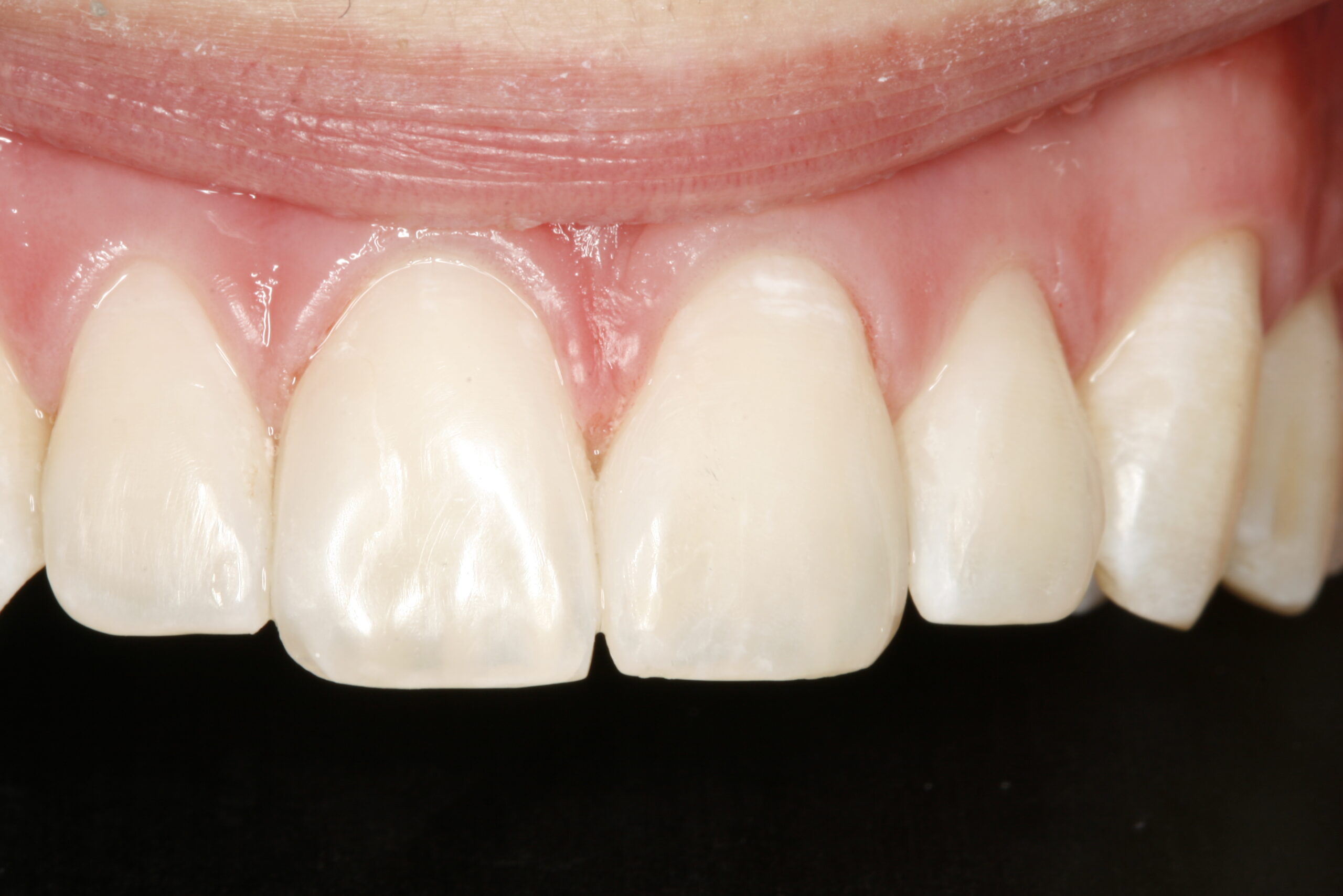 After bonding dental procedure showing great smile.