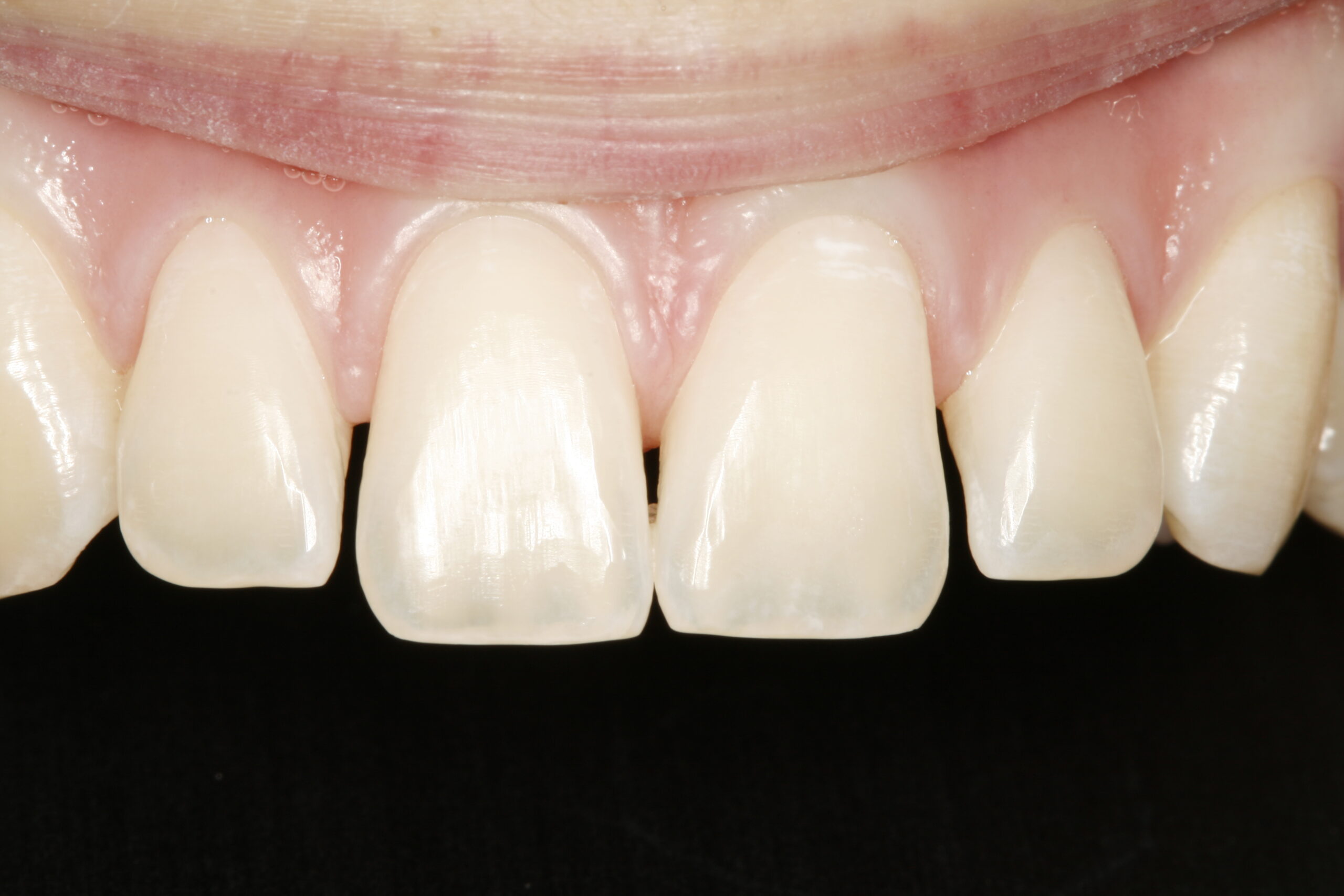 Before bonding dental procedure.
