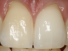 After single tooth color correction dental procedure.