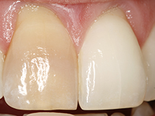 Before single tooth color correction dental procedure.