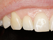 After single tooth color correction dental procedure.