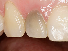 Before single tooth color correction dental procedure.