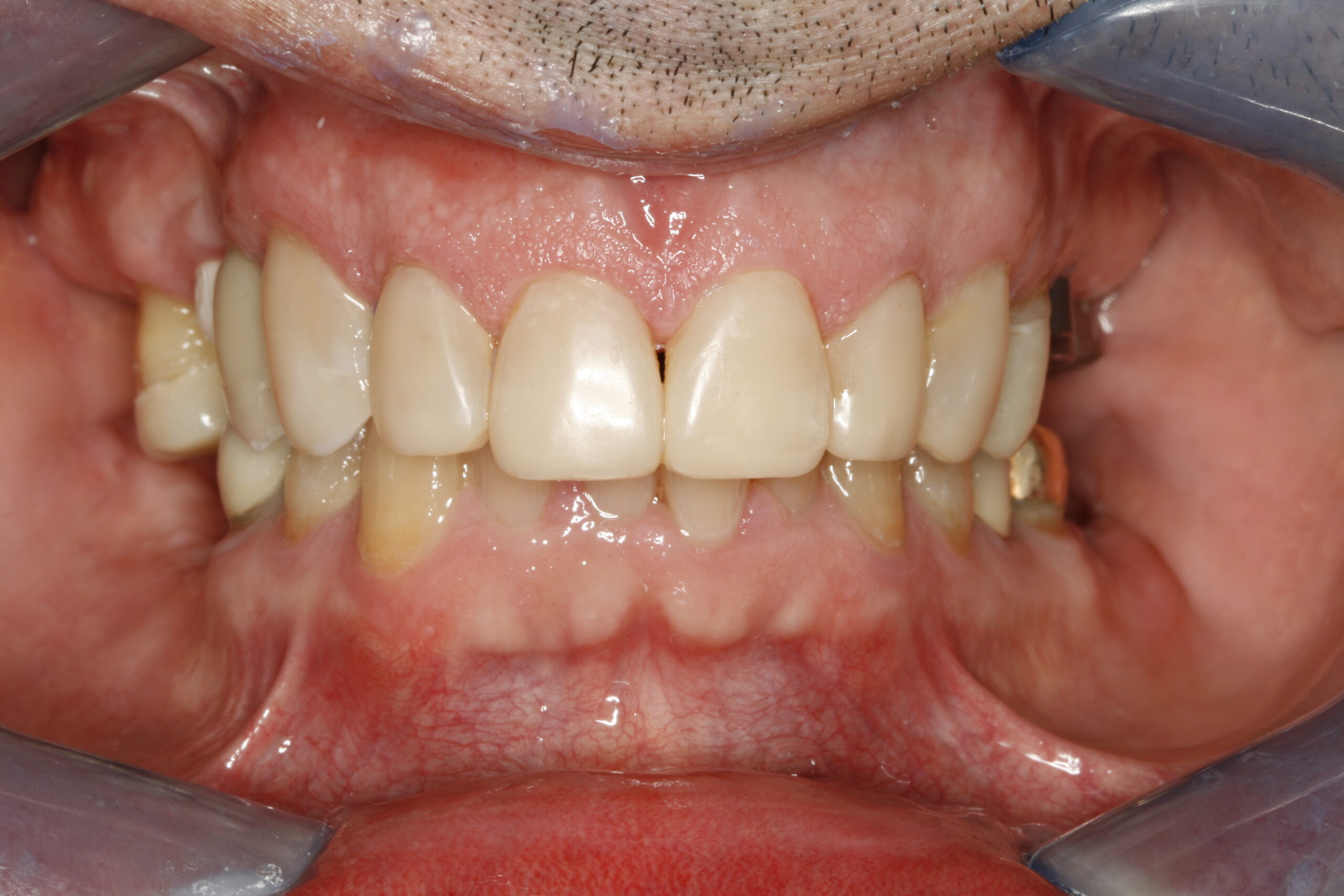 After professional dental transitional bonding showing improved teeth and smile.