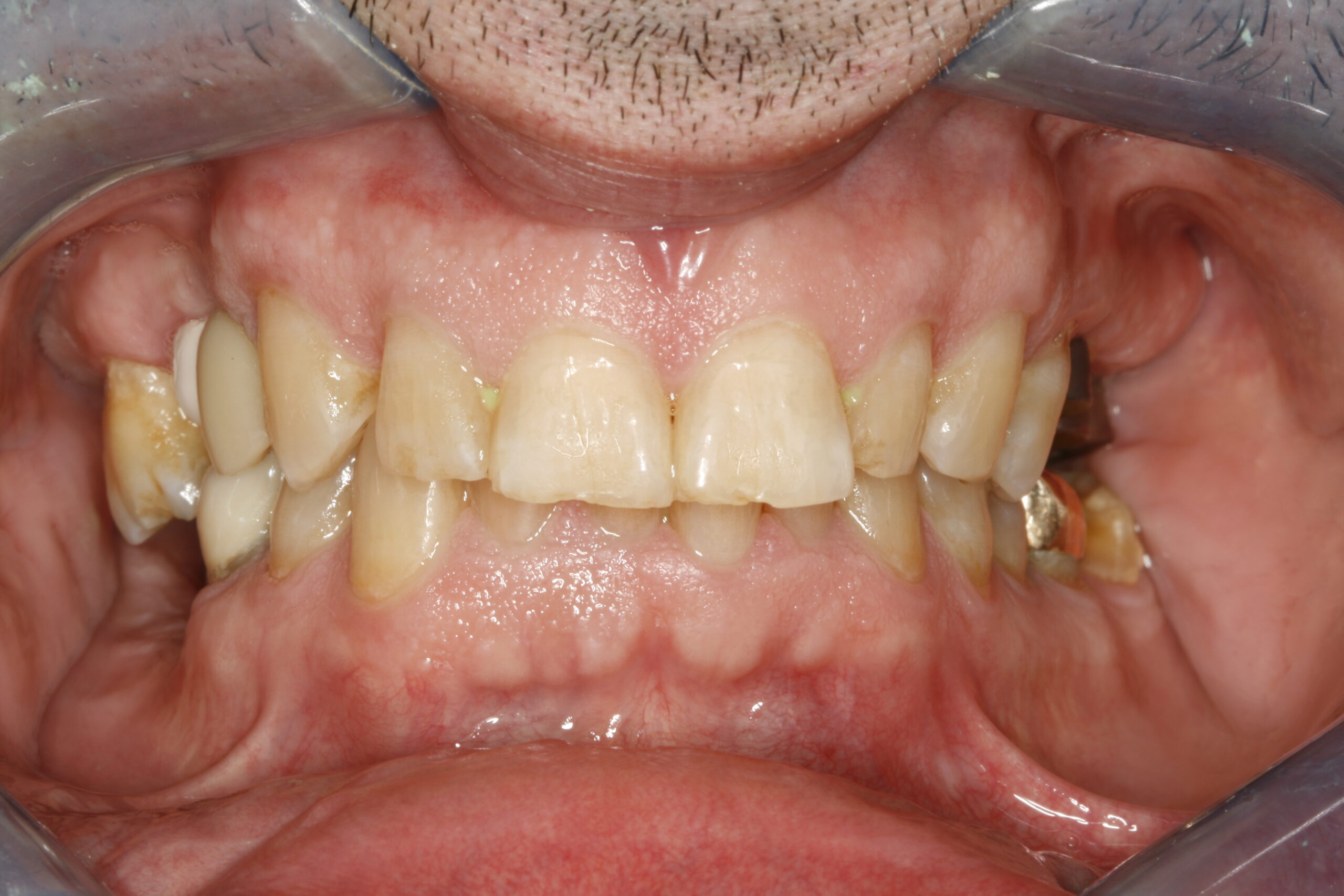 Before professional dental transitional bonding showing problem teeth.