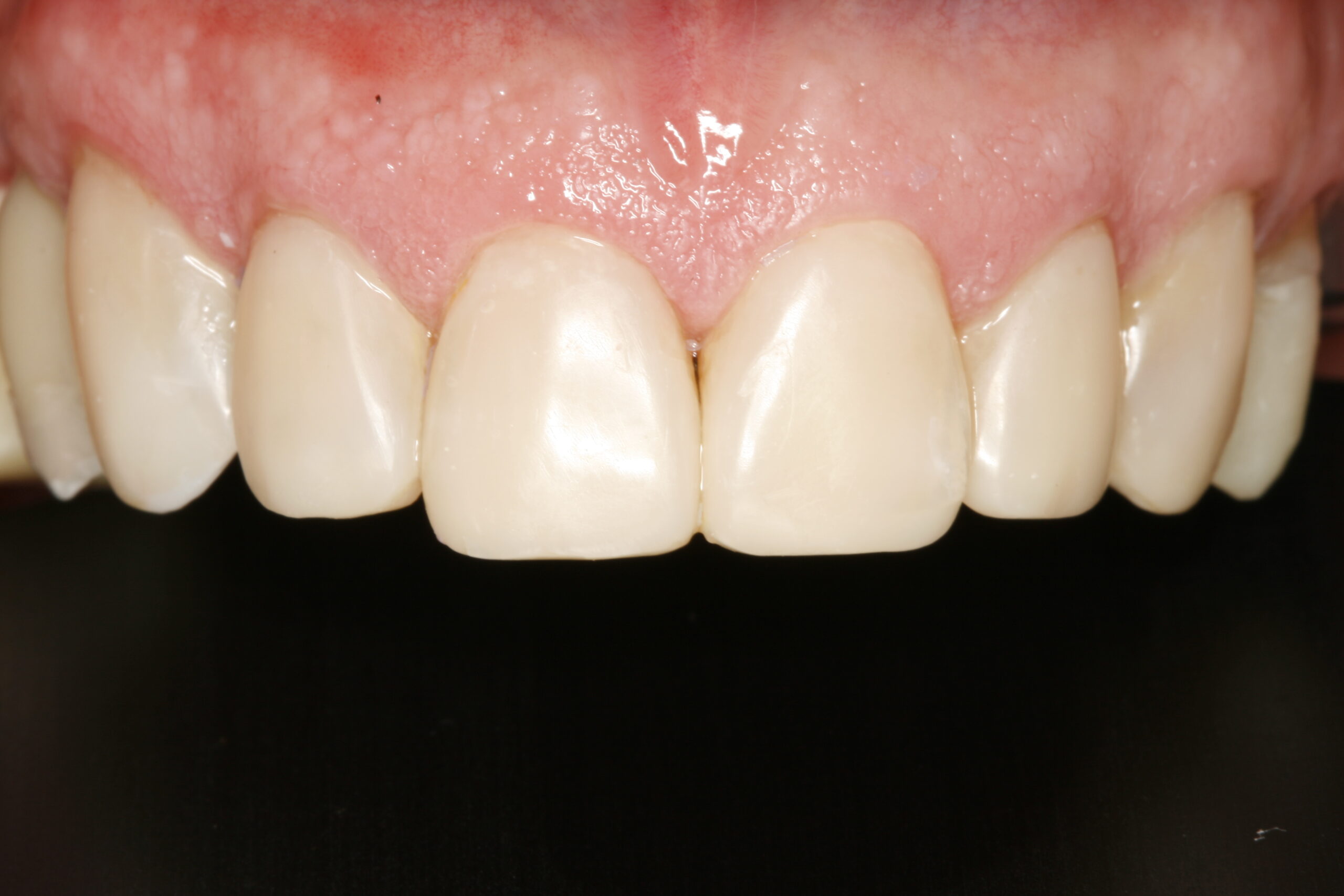 After transitional bonding dental procedure showing great smile.