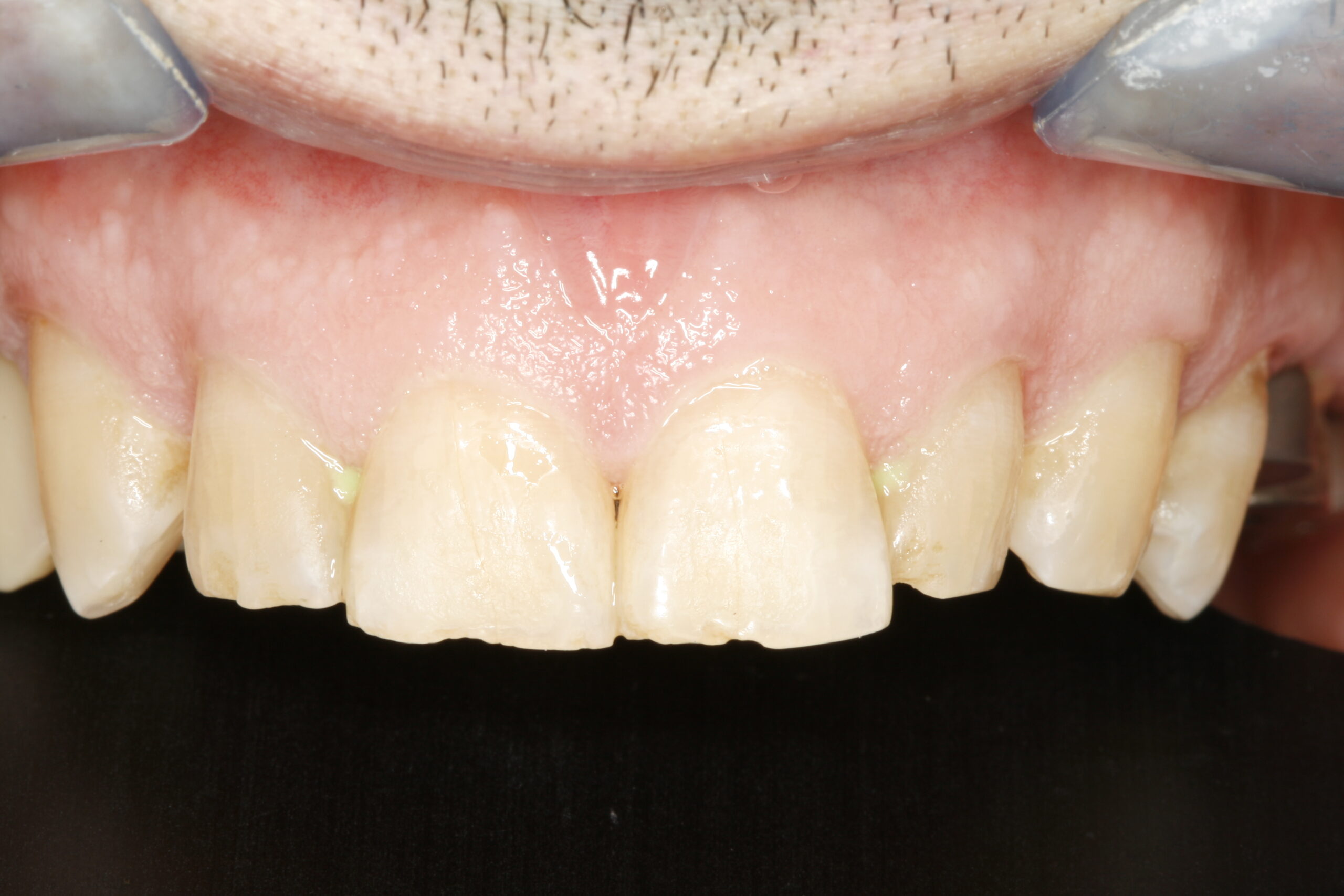 Before professional dental transitional bonding showing problem teeth.