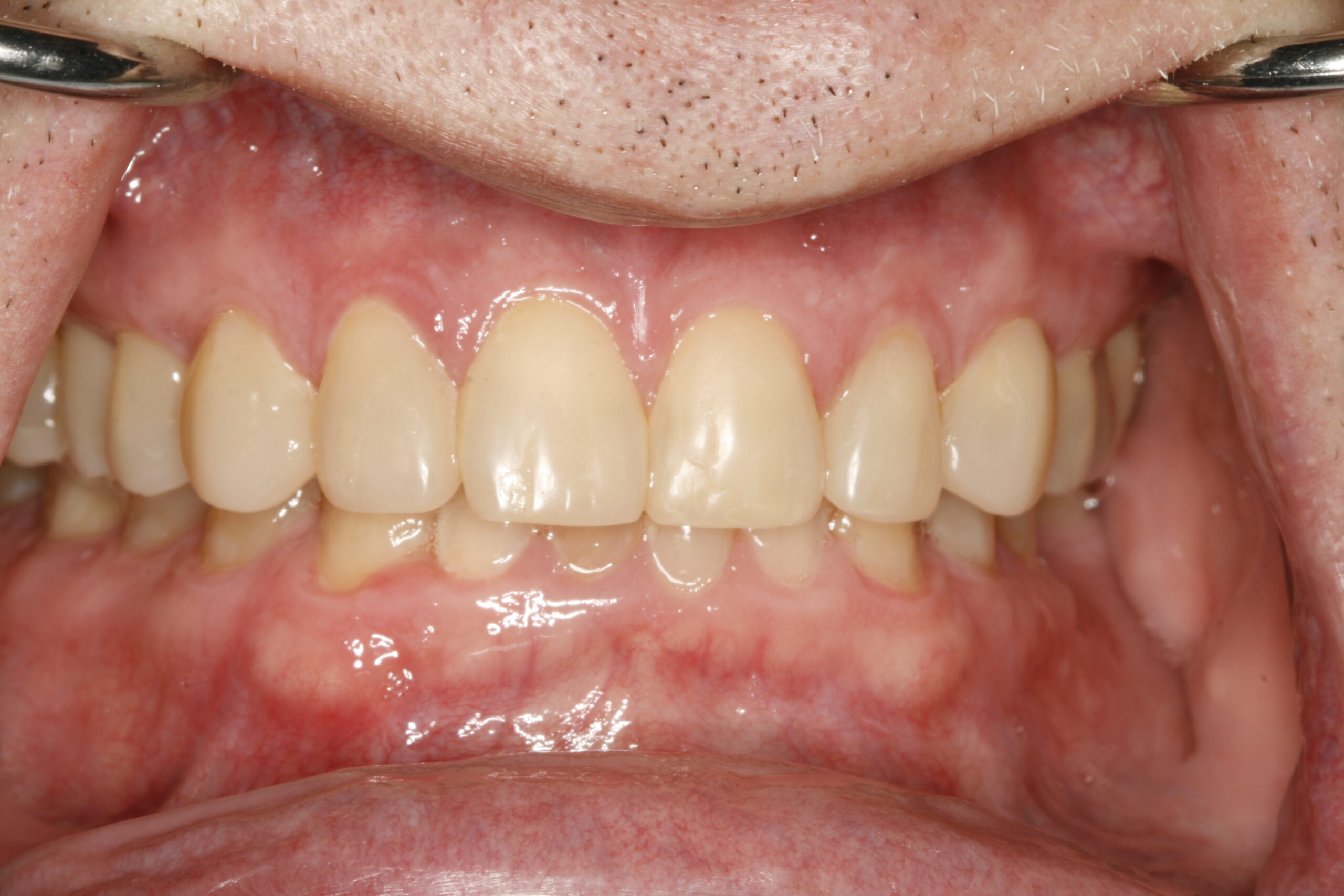 After transitional bonding dental procedure showing great smile.