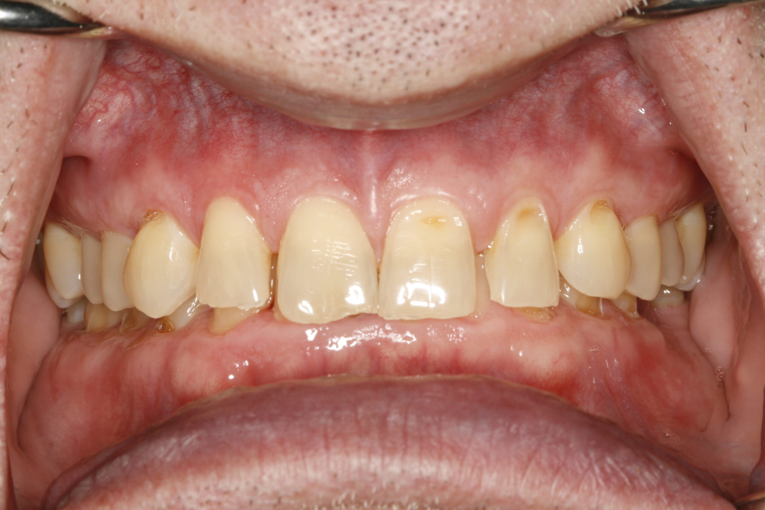 Before dental transitional bonding showing problem teeth.