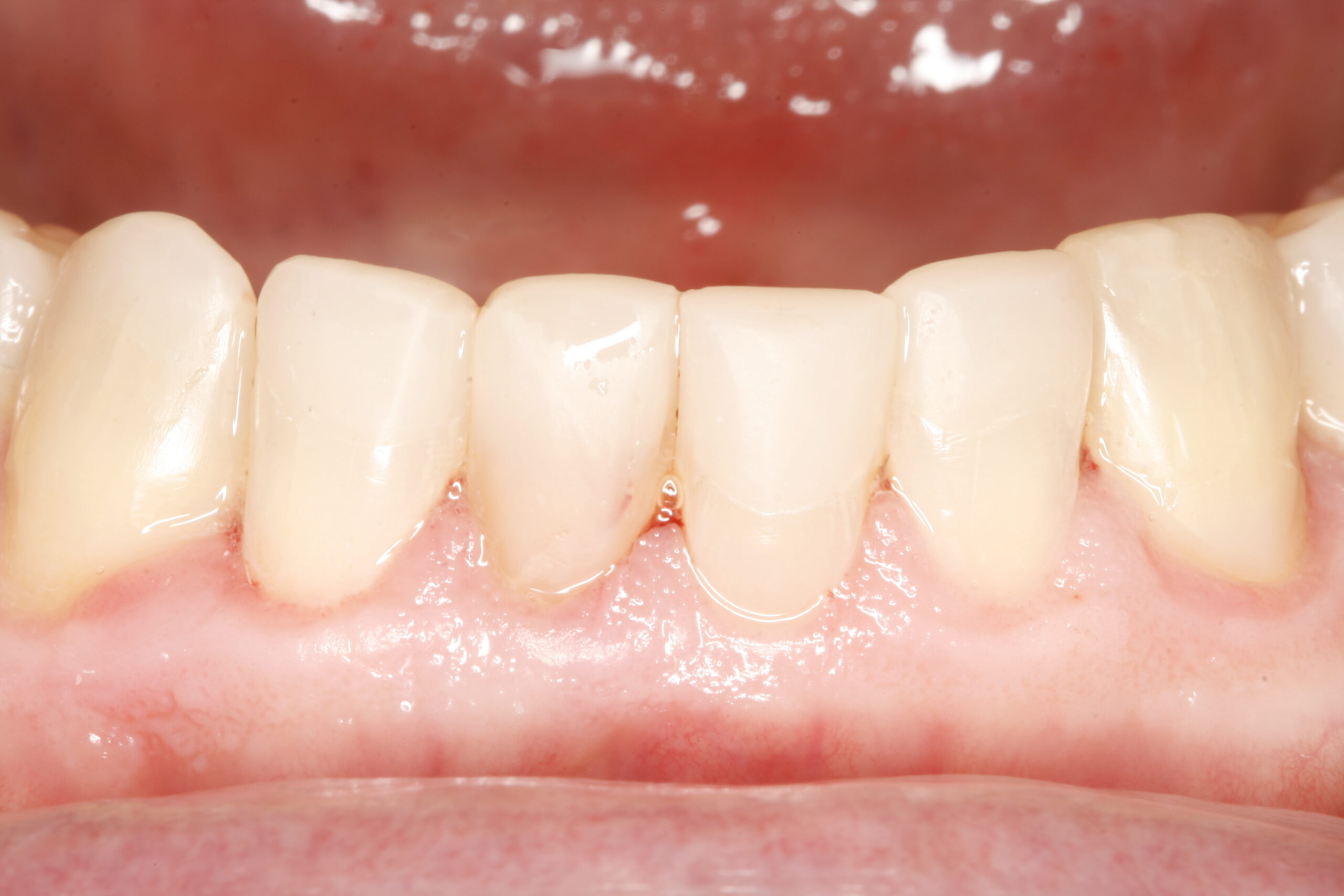 After transitional bonding dental procedure showing great smile.