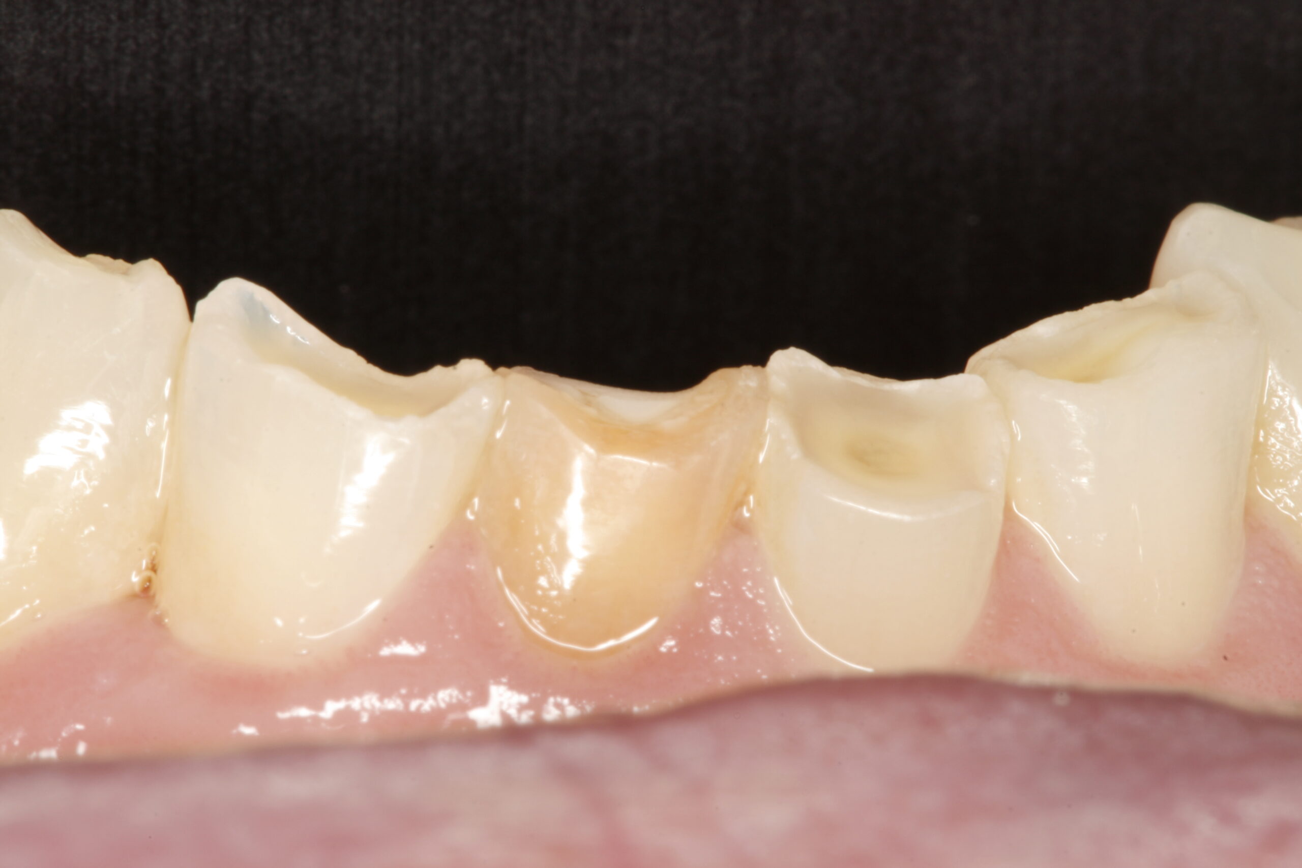 Before professional dental transitional bonding showing problem teeth.