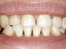 After professional dental teeth restoration showing fixed teeth.
