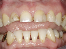Before professional dental teeth restoration showing teeth with problems.