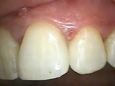 After professional dental teeth restoration showing fixed teeth.