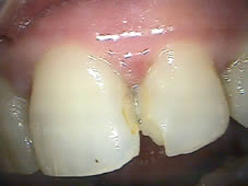 Before professional dental teeth restoration showing teeth with problems.