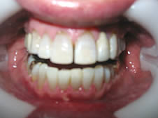 After professional teeth whitening treatment showing improved teeth.