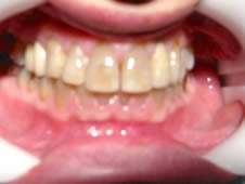Before professional teeth whitening treatment showing stained teeth.