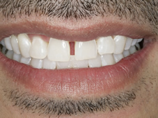 After professional teeth whitening treatment showing improved teeth.