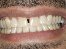 Before professional teeth whitening treatment showing stained teeth.